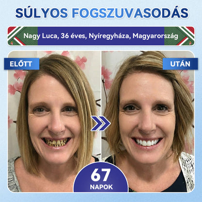 𝐺𝑙𝑖𝑚𝑚𝑒𝑟𝑙𝑦® 𝑇𝑖𝑑𝑒𝑔𝑙𝑢𝑠𝑖𝑏 𝑓𝑜𝑔- é𝑠 í𝑛𝑦𝑗𝑎𝑣í𝑡ó 𝑔𝑦𝑜𝑟𝑠𝑎𝑛 𝑜𝑙𝑑ó𝑑ó 𝑠𝑧á𝑗𝑐𝑠í𝑘𝑜𝑘   口溶贴片 1.0匈牙利